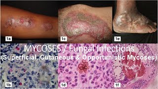 Mycoses  Fungal Infections  Superficial Cutaneous amp Opportunistic Mycoses  Microbiology Lecture [upl. by Jariah]