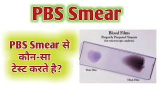 PBS slide  Periferal blood smear  PBS test [upl. by Hairem]