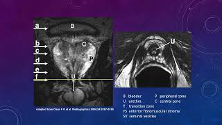 Introduction to PIRADS [upl. by Hammerskjold41]