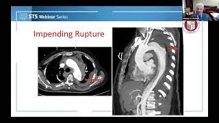 Management of Type B Aortic Dissection Takeaways from the STSAATS Guideline March 17 2022 [upl. by Rodama431]