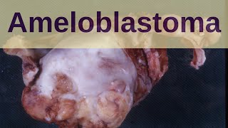 Ameloblastoma  Pathology mini tutorials [upl. by Anilys]