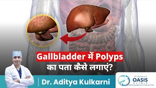 Gallbladder में Polyps का पता कैसे लगाएं  Dr Aditya Kulkari [upl. by Draper213]