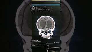 Hydrocephalus  Babay CT  Head anatomy  Findings of Head  Medical Imaging  Brain CT [upl. by Perren]