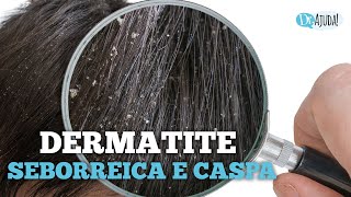 DERMATITE SEBORREICA E CASPA QUAIS SÃƒO AS CAUSAS E O QUE FAZER [upl. by Norak793]