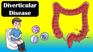 Diverticular Disease And Diverticulitis  Causes Signs amp Symptoms Diagnosis Treatment [upl. by Law490]