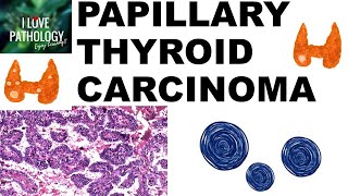 PAPILLARY THYROID CARCINOMA  Gross and Microscopic features [upl. by Dorman342]