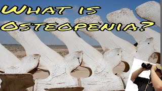 What is Osteopenia A brief description of what osteopenia and osteoporosis are [upl. by Mackay]