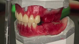 What is OM DENTURE SYSTEM [upl. by Adamina839]