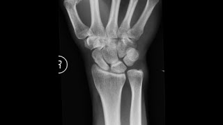 TFCC TEAR REPAIR ULNAR OSTEOTOMY SURGERY FINAL OUTCOME [upl. by Hnahc]