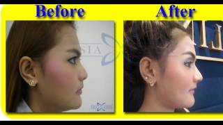 BeforeAfter Nose Surgery  Rhinoplasty  Thailand [upl. by Grannias]