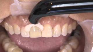 How to Complete an Anterior Dental Restoration with Kerrs Nexus RMGI [upl. by Romeon]