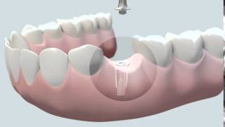 Cómo se coloca un implante dental [upl. by Vez]