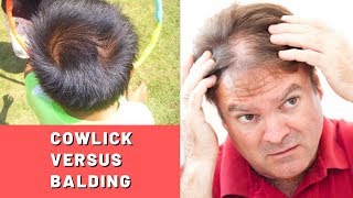 Cowlick vs Balding Is It Actually An Early Sign of Hair Loss [upl. by Isidor104]