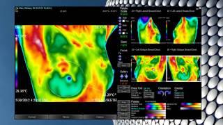 Anthony Thermography Software [upl. by Nodmac]