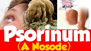 Psorinum homeopathic medicine  Nosodes  Psorinum and its Comparison  Psorinum full explanation [upl. by Blackburn223]