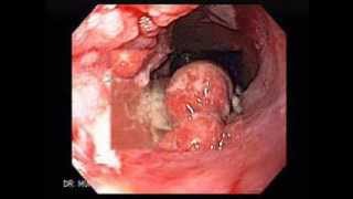 Esophageal cancer pictures [upl. by Nosral]