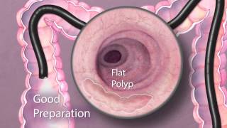 The Importance of Good Bowel Preparation During Colonoscopy [upl. by Yllet]