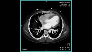 Coarctation of the Aorta [upl. by Maxi358]