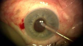 Cataract Surgery in the Severe Flomax Patient [upl. by Anavlys]