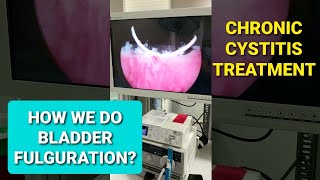 Urinary Tract Infection Chronic Recurrent Cystitis Treatment BLADDER FULGURATION [upl. by Aikemal]