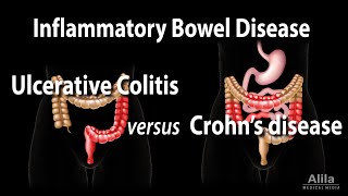 Ulcerative Colitis versus Crohns Disease Animation [upl. by Gentry15]