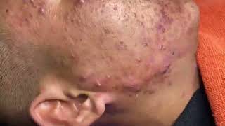 Loan Nguyen Acne Treatment 11399 [upl. by Ennylyak768]