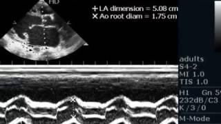 MITRAL VALVE PROLAPSEECHOCARDIOGRAPHY SERIES BY DRANKURKCHAUDHARI [upl. by Nnaerb]