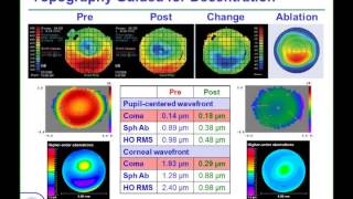 LoVC Course on Therapeutic Corneal Refractive Surgery Part 3 of 6 Decentration [upl. by Eitsim]