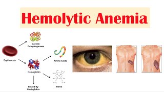 Hemolytic Anemia [upl. by Carthy]