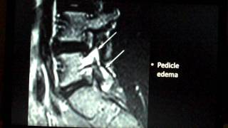 Spine Lecture Spondylolysis [upl. by Ennaid]