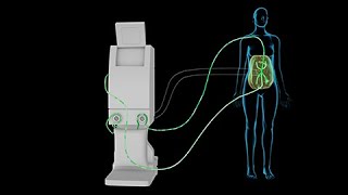 Quimioterapia intraperitoneal caliente HIPEC [upl. by Nodyl]