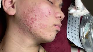 Make your Acne Treatment Huong Da Nang501  acne 2022 PArt 2 [upl. by Eiluj]