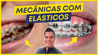 ELÁSTICOS ORTODÔNTICOS PRINCIPAIS INDICAÇÕES E EFEITOS NOS DENTES [upl. by Dibbell]