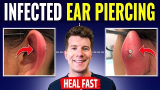 Doctor explains HOW TO RECOGNIZE AND TREAT INFECTED EAR PIERCING [upl. by Brewster]