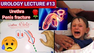 Urology surgery lecture 13 penile carcinoma 🌹 Sexually transmitted disease genital warts HPV [upl. by Walls]