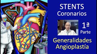 Stent Coronario 1a Parte ✅ Angioplastía Coronaria Placas de Colesterol 🔔 [upl. by Stearne]