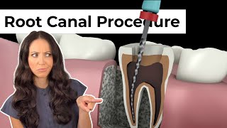 Root canal preparation with rotary flies Rotary endodontics part 2 Rotary endo for beginners [upl. by Roger]