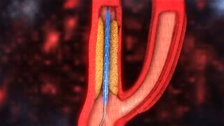 Carotid Artery Stenting video [upl. by Willi]