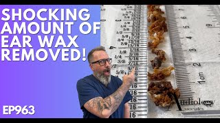 The Most Shocking Ear Wax Removal Ever  EP963 [upl. by Ennagrom]