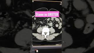 Stone in Ureter  CT KUB viral youtubeshorts shortsfeed [upl. by Nadine677]