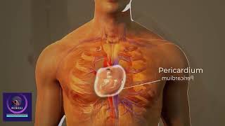 Cardiac Tamponade Treatment  Cardiac Surgery Procedure 3D Animation [upl. by Debor]