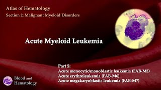 Acute Myeloid Leukemia AML  Part 5 [upl. by Nehtanoj743]