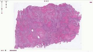 Histopathology  Squamous Cell Carcinoma of the Lung [upl. by Rehctelf]