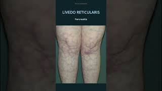 Livedo Reticularis Causes osce practicalmedicine diagnosis sle [upl. by Alfons]