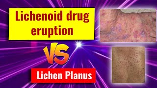 Lichenoid drug eruption features and comparison with lichen planus [upl. by Anniahs364]