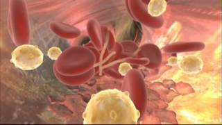 Video sobre la Ateroesclerosis [upl. by Baker353]