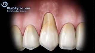 Patient Treatment Videos Gingival Graft Alloderm [upl. by Robison]