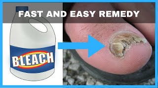 How to Get Rid of Toenail Fungus with Bleach  Toe Fungus Journey [upl. by Oruhtra722]