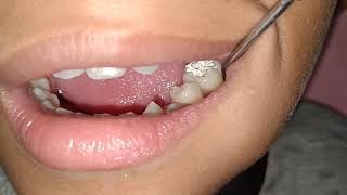 Tambal gigi berlubang  Tambal gigi sementara  Temporary Filling  Tooth Decay  Dentist [upl. by Marsha]