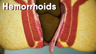 Hemorrhoidsdifferent types of hemorrhoids internal and external Hemorrhoids Hemorrhoids treatment [upl. by Infield]